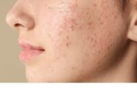 FORMATION PRATIQUE EN TRAITEMENT DE L'ACNE – Image 2